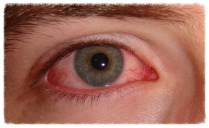 Chronic Red Eye